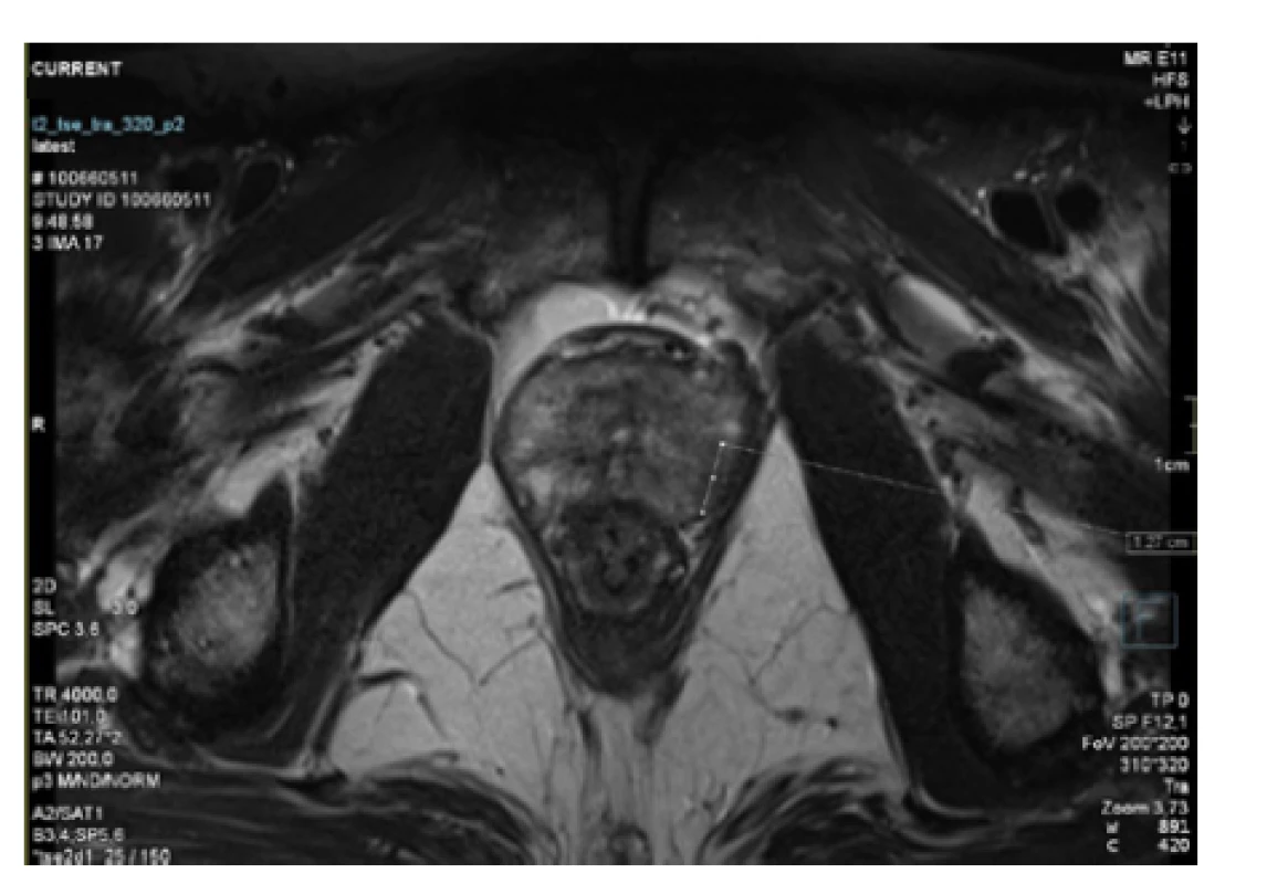 3T MRI prostaty s označeným ložiskem v levém
laloku<br>
Fig. 1. 3T MRI of the prostate with tumour in the left
lobe