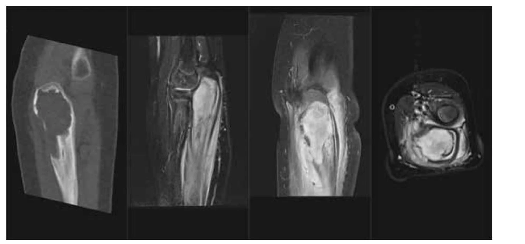 LCH – kostní tumor: a) CT scan v kostním okně, nativně, osteolytické ložisko proximální ulny
a olecranu, b) MR T2 STIR scan v sagitálním řezu, solidní infiltrace kostní dřeně proximální ulny, periostální
reakce, c) MR T1 scan s potlačením tuku v sagitální rovině, tumor kosti, extraoseální šíření
a periostální reakce, d) MR T1 s potlačením tuku v axiální rovině, tumor proximální ulny s extraoseální
propagací.<br>
Fig. 2. LCH – tumor of proximal ulna: a) lytic lesion on CT scan, b) soft tissue tumor, edema and periostosis
of the ulna on MR STIR scan, c) enhancing tumor with extraosseoal spred on T1 fs in sagital plane and d)
in axial plane.
