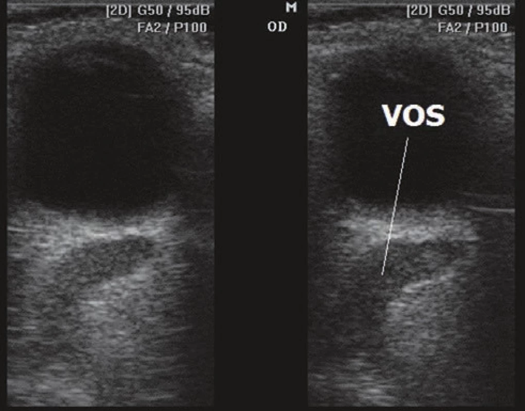 Dilatácia echa vena orbitalis superior (VOS)
pomocou ultrasonografie B-scan pri karotído-kavernóznej
fistule