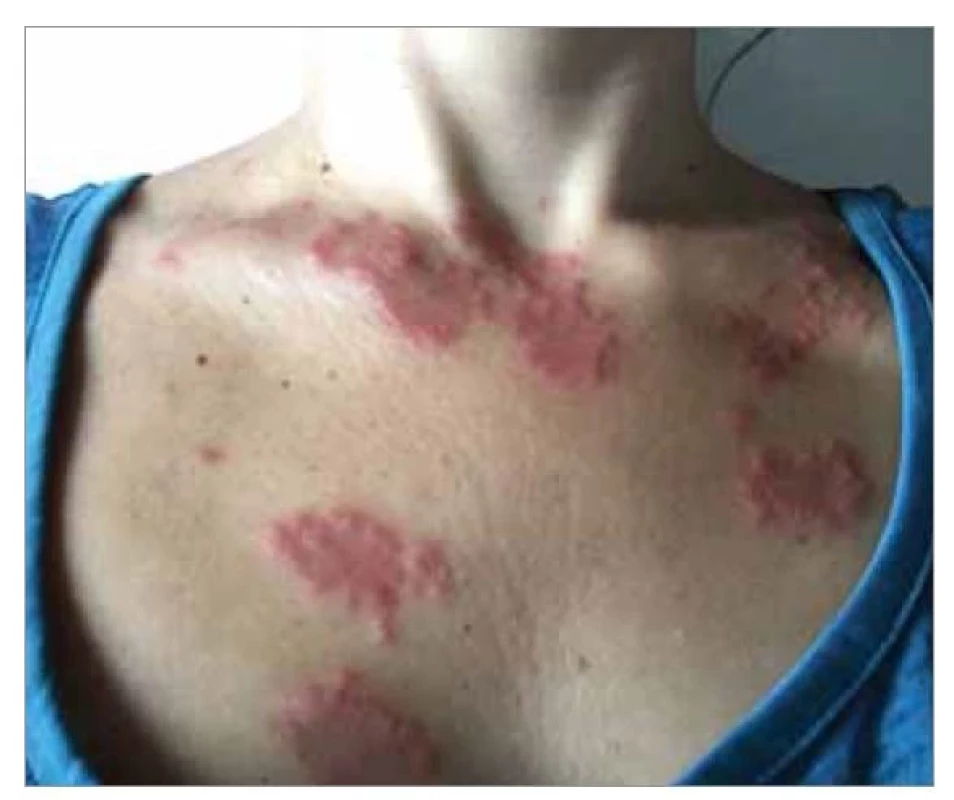 Kožní léze – Sweetův syndrom.<br>
Fig. 1. Skin lesions – Sweet’s syndrome.