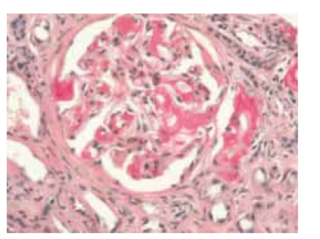 Histologický obraz glomerulu
ledviny, pozitivní amyloid sytě červený
(barvení saturnovou červení).<br>
Fig. 4. Histological image of a renal glomerulus,
positive amyloid is deep red
(saturn red staining).