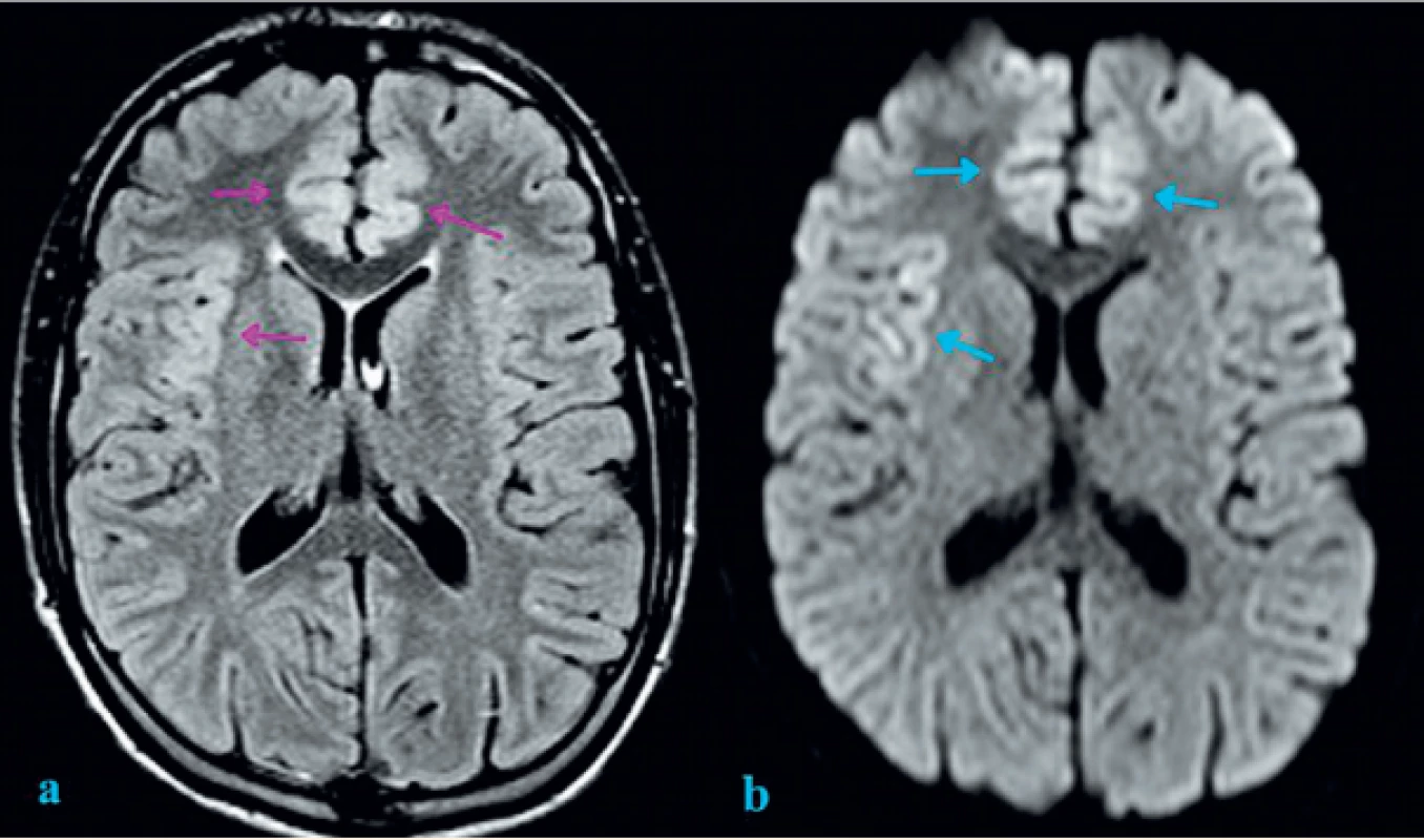 Zobrazení mozku magnetickou rezonancí: FLAIR (Fluid-attenuated inversion recovery) a DWI (difuzně vážená sekvence).<br>
a) FLAIR sekvence s nálezem mírného rozšíření a zvýšeného signálu kortexu oboustranně frontomediálně a inzulárně vpravo (fialové šipky);<br>
b) DWI se známkami restrikce difuze inzulárně vpravo a frontomediálně oboustranně (modré šipky). Restrikce difuze může<br>
být známkou cytotoxického edému v rámci neurotoxické encefalopatie.<br>
Fig. 1. Brain magnetic resonance imaging: FLAIR (Fluid-attenuated inversion recovery) and DWI (Diffusion-weighted magnetic
resonance imaging).<br>
a) Cortical thickening and increased FLAIR signal intensity of insular cortex on the right and frontomedial cortex bilaterally
(purple arrows);<br>
b) Diffusion restriction involving right insular cortex and frontomedial cortex bilaterally (blue arrows). Diffusion restriction
can be an indicative marker of cytotoxic edema as sign of neurotoxic encephalopathy