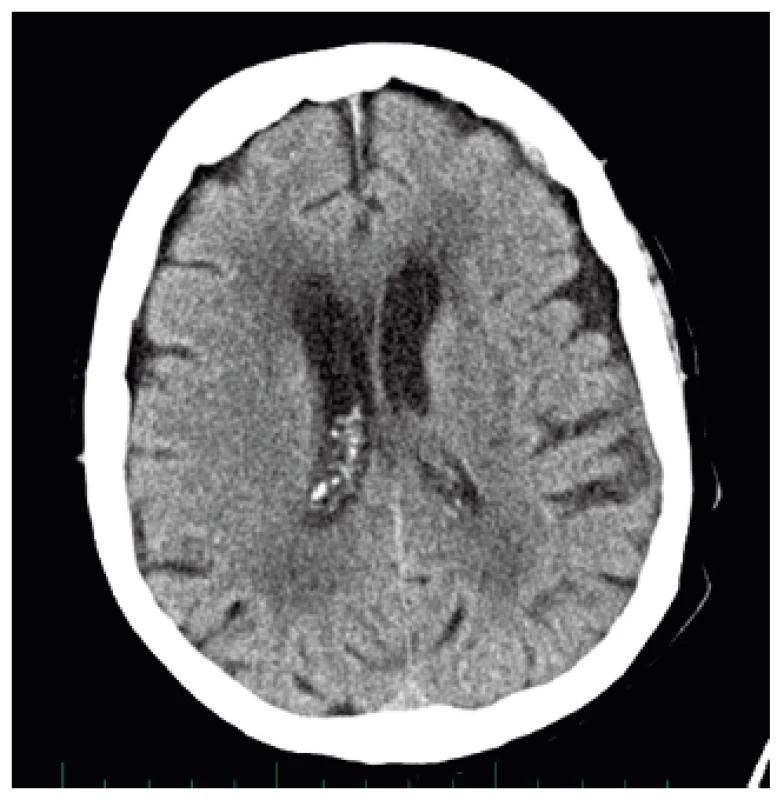 CT mozku s nálezem difúzní
mozkové atrofie bez známek nitrolebního
krvácení či jiné vysvětlující patologie