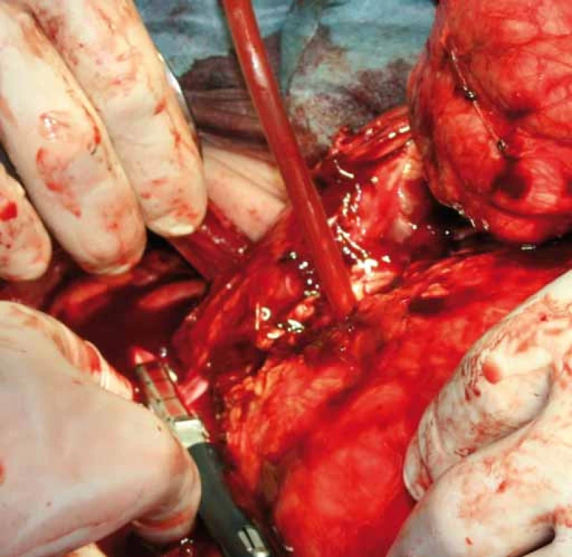 Přerušení cévního svazku levé ledviny staplerem.