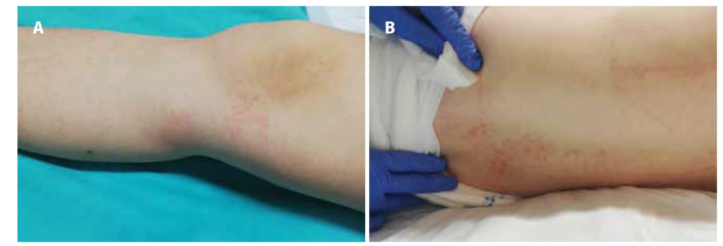 A, B. Makulózny exantém na nohách (A) a chrbte (B) pacientky z klinického prípadu 2.<br>
Fig. 3A, B. Macular rash on the legs (A) and back (B) of the patient from case report 2.