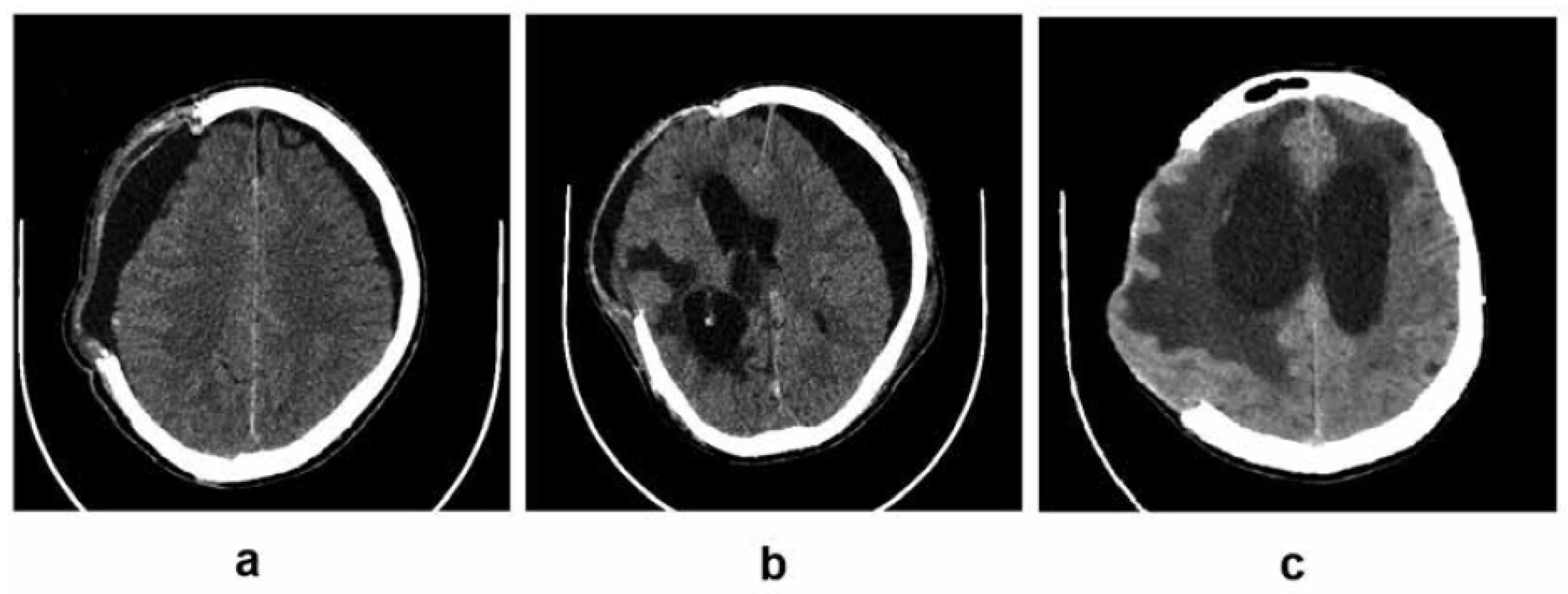 Komplikácie vyplývajúce z narušenej likvorovej dynamiky:<br>
3a – bilaterálne subdurálne hygrómy, predominantne na strane kraniektómie; 3b – bilaterálne subdurálne
hygrómy, predominantne kontralaterálny hygróm vyvolávajúci kompresiu a externú herniáciu mozgu, presun
stredočiarových štruktúr, ventrikulomegália; 3c – hydrocefalus (archív autora)<br>
Fig. 3. Complications resulting from impaired cerebrospinal fluid dynamics:<br>
3a – bilateral subdural hygromas, predominantly at the site of craniectomy; 3b – bilateral subdural hygromas,
predominantly contralateral hygroma causing brain compression, external herniation and midline
shift, ventriculomegaly; 3c – hydrocephalus (author’s archive)