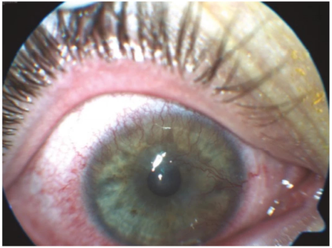  Right eye of patient from case report 1, visible
mixed corneal vascularisation