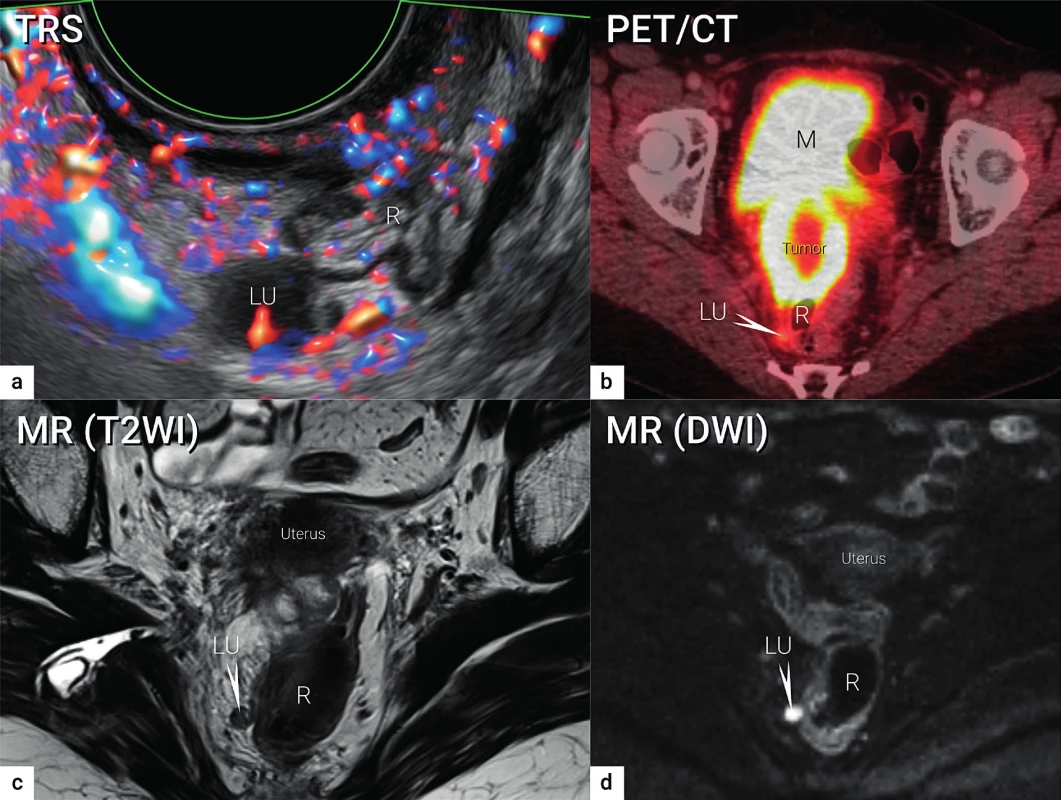 Zobrazení lymfatických uzlin<br>
Viscerální metastatická lymfatická uzlina o velikosti 10 mm uložená v pravém sakrouterinním vazu podle transrektálního ultrazvuku (a),
PET/CT (b), MR (T2WI)(c) a MR (DWI)(d).
TRS – transrektální ultrazvuk; PET/CT – pozitronová emisní tomografie fúzovaná s CT; MR (T2WI) – magnetická rezonance s T2 váženými
obrazy (T2WI, T2 weighted images); MR (DWI) – magnetická rezonance se zobrazením difuze (DWI – diffusion weighted images); LU –
lymfatická uzlina (označena šipkou v b, c, d); R – rektum; M – močový měchýř
