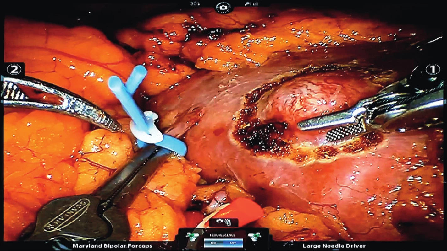 Demarkace nádoru levé ledviny pomocí
elektrokoagulace