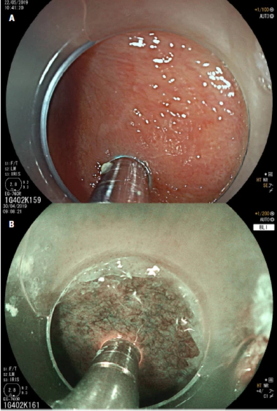 Endoscopic view in high-definition white-light endoscopy (HD-WLE) (a) and blue light imaging (BLI) (b) of nondysplastic Barrett´s esophagus investigated with the confocal probe Cellvisio®