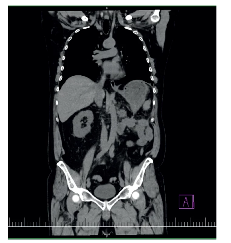 Pooperačný stav po nefrektómii<br>
Fig. 10: Postoperative condition after nephrectomy