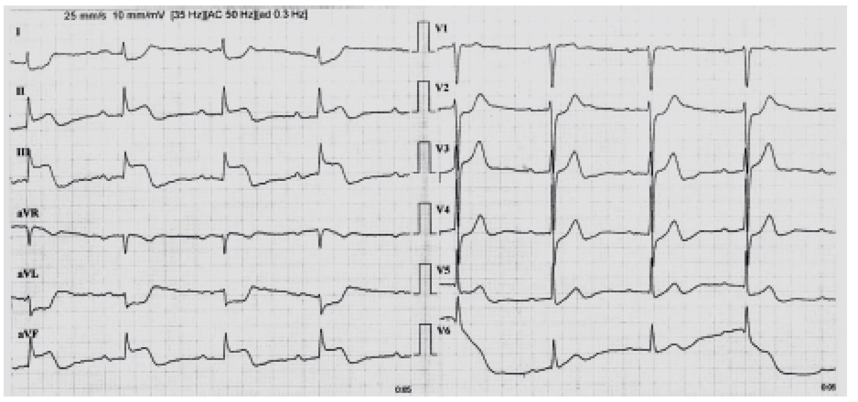 EKG křivka 2 během trombolýzy při konzultaci
kardiologa
