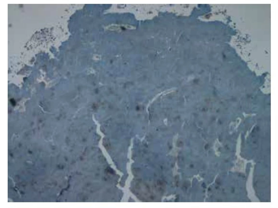 Imunohistochemické vyšetření v reakci s protilátkou proti amyloidu
A bez známek pozitivity. Původní zvětšení snímku 40x