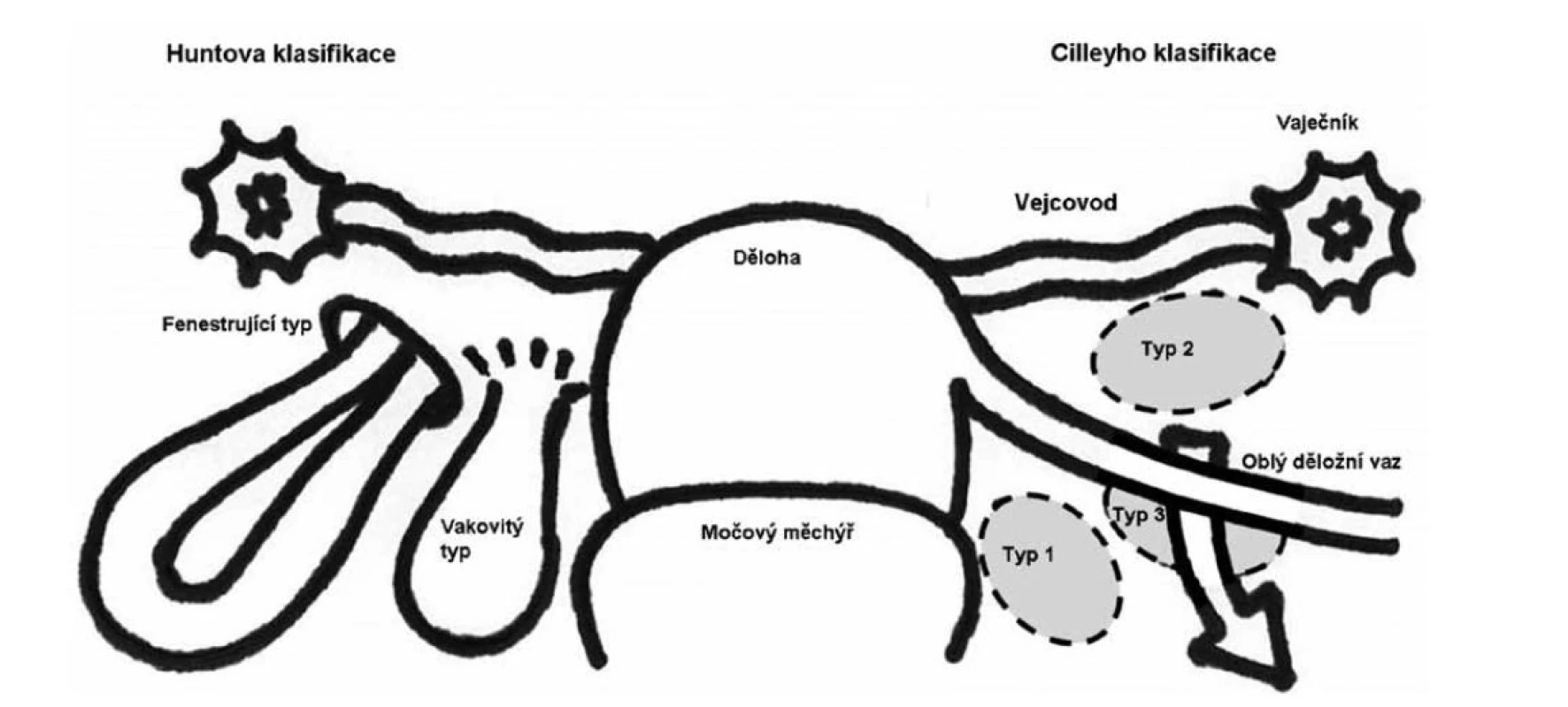 Klasifikace defektů děložních vazů [3]<br>
Fig. 1: Classification of uterine ligament defects [3]
