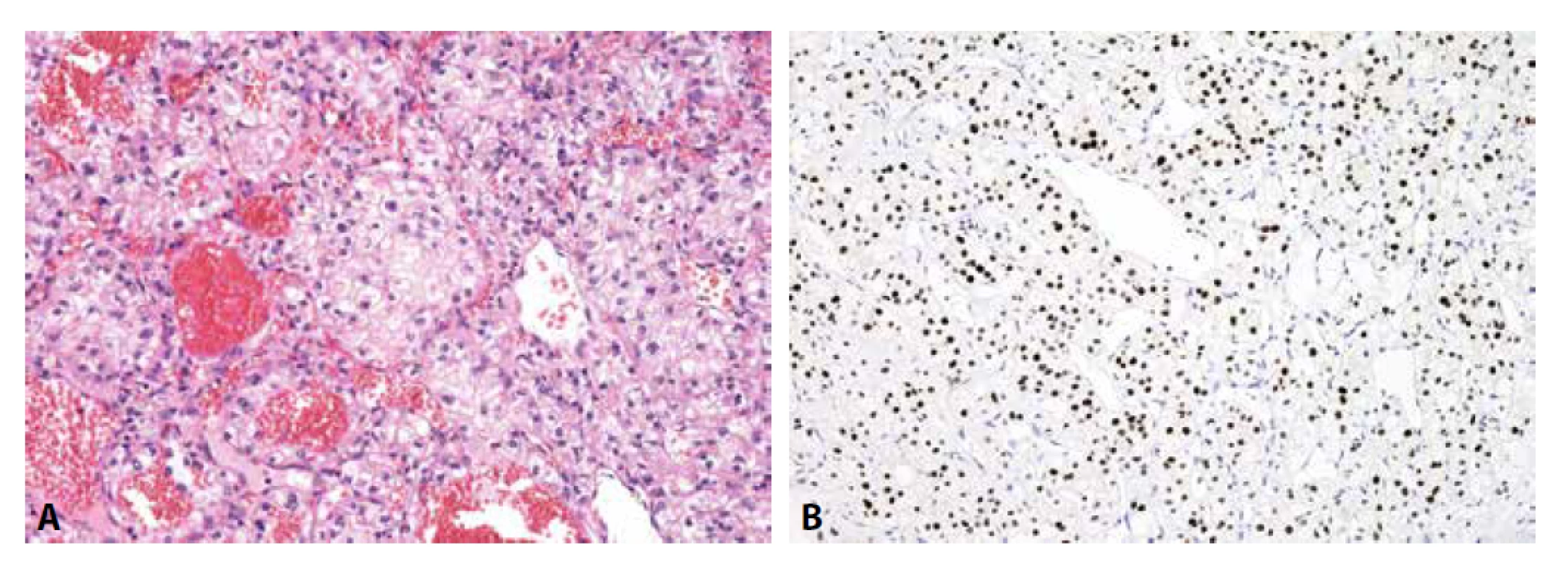 Metastáza světlobuněčného renálního karcinomu A) drobné shluky okrouhlých buněk s vodojasnou cytoplazmou (H&E); B) jaderná
exprese PAX8 (zvětšení x200).
