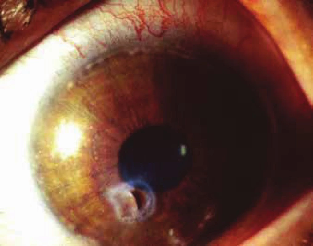 Peripheral infiltration in perimeter of cornea and paracentral
perforation of infiltrated cornea