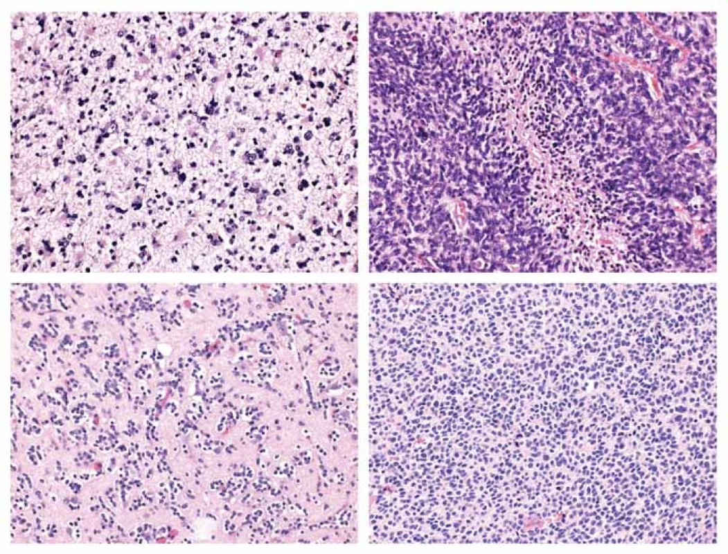 Typická morfologie infiltrujících gliomů.<br>
A) Difúzní astrocytom, středně celulární nádorová proliferace tvořena atypickými fibrilárními astrocyty.<br>
B) Glioblastom, hypercelulární tumor s palisádující nekrózou.<br>
C) Oligodendrogliom, středně celulární proliferace oválných buněk s perinukleárním projasněním v síti bohatě větvených kapilár.<br>
D) Anaplastický oligodendrogliom, hypercelulární proliferace s briskní mitotickou aktivitou.<br>
A–D) Hematoxylin-eozin, původní zvětšení 200×