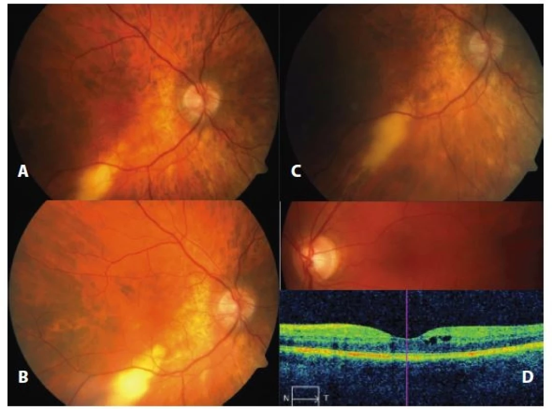 Development of chorioretinal finding in three stages (a, b, c) in a patient upon simultaneous neurosarcoidosis and hilar lymphadenopathy and finding of CME together with change on OCT (d) in patient with intermediate uveitis secondary to hilar lymphadenopathy with sarcoidosis
