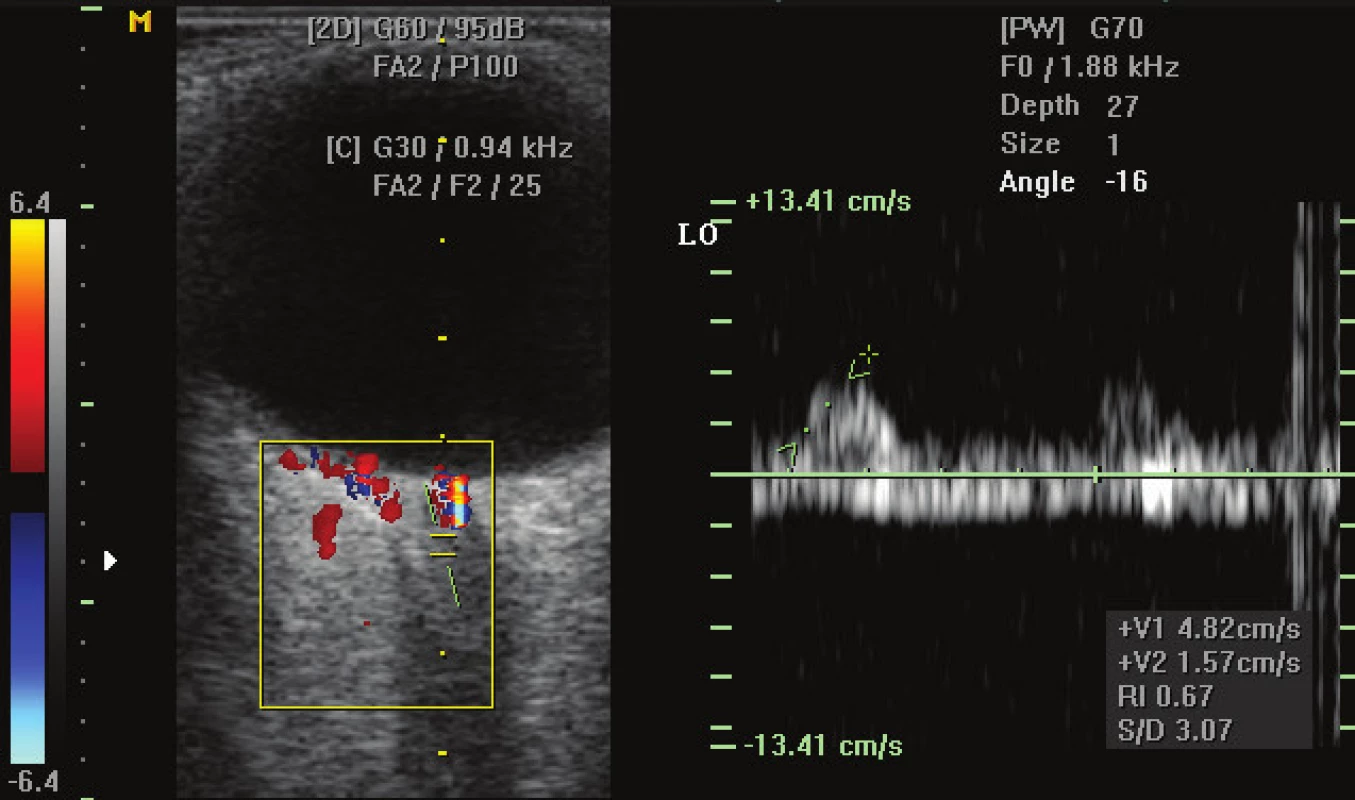 Colour Doppler ultrasonography – pronouncedly low flow parameters in
central retinal artery