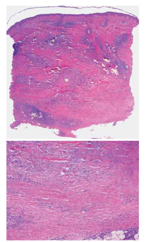 Necrobiosis lipoidica<br>
a) horizontálně probíhající nekrobiotické okrsky vaziva obklopené
perivaskulárním a intersticiálním zánětlivým infiltrátem
(HE 25x)<br>
b) nekrobiotický okrsek zrnitě se rozpadajícího vaziva
(HE 100x)