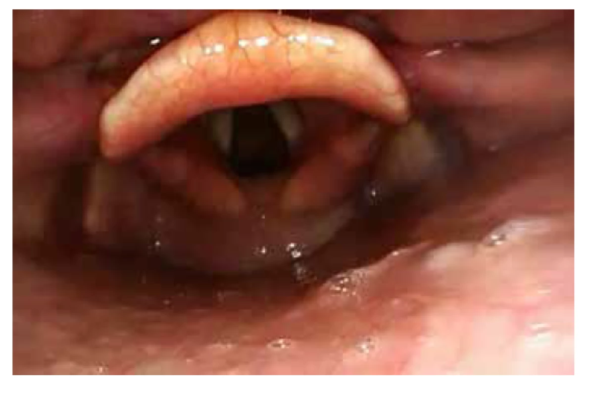 Epiglotis u dospělého člověka