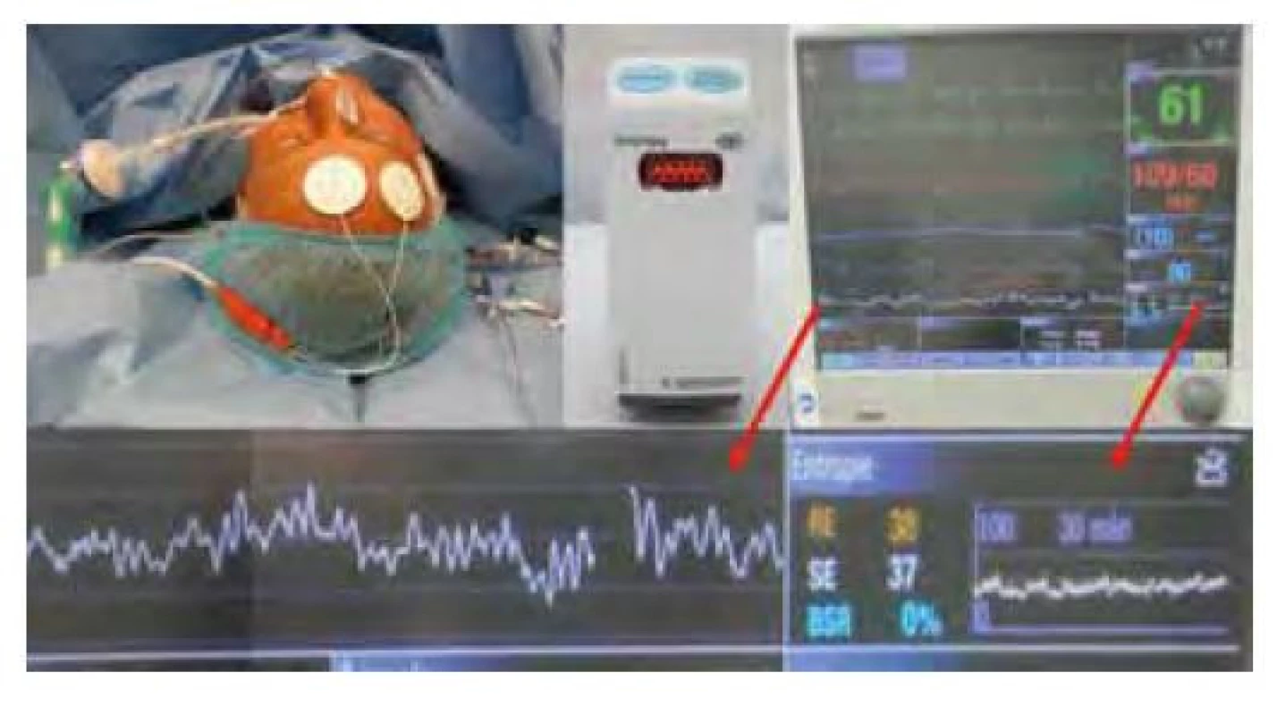 Pacient s elektrodami GE Entropy, modul, záznam entropie na
monitoru a detail záznamu, na němž je jeden svod EEG, hodnoty RE (Resting
Entropy) 38, SE (State Entropy) 37, BSR (Burst Suppression Ratio) 0 % a trend
hodnot RE a SE v posledních 30 minutách lehce pod doporučeným rozmezím
40–60
