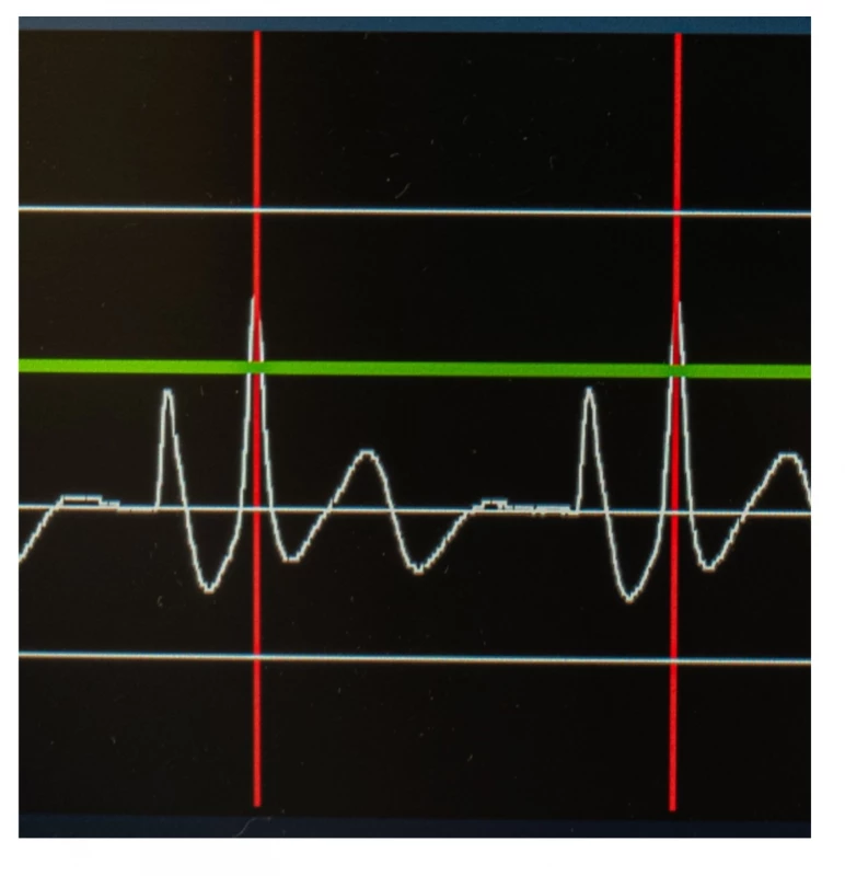 Intravazální EKG, dosažení maximální amplitudy vlny P při kavoatriální poloze konce katetru 