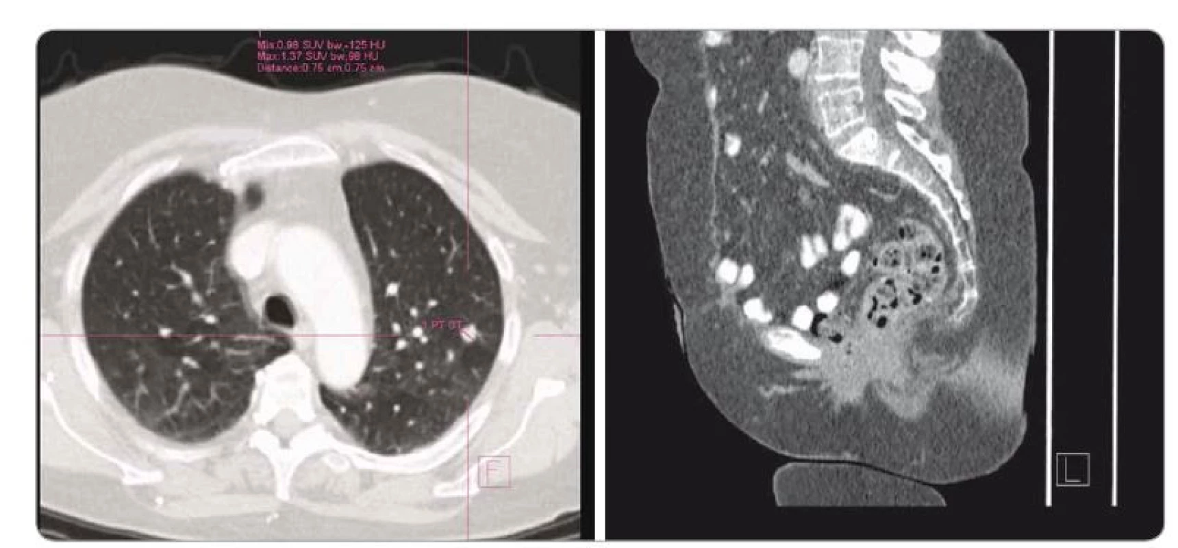 PET/CT v 1/2016. Metastázy v obou plicních křídlech. Vlevo 3 metastázy < 8 mm, vpravo 5 metastáz < 1 cm + recidiva v malé pánvi.