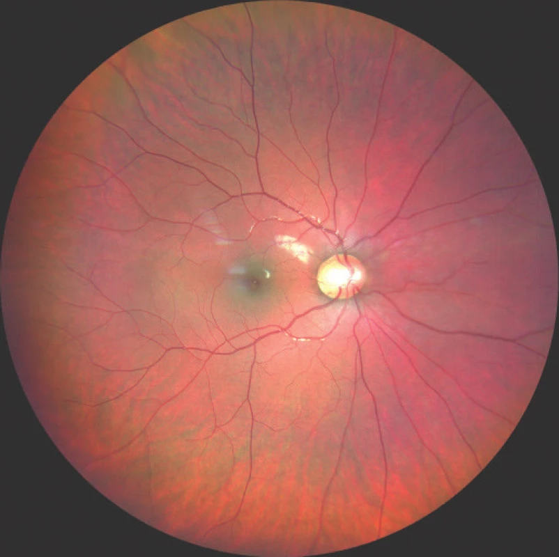 Photograph of fundus of right eye, ODP