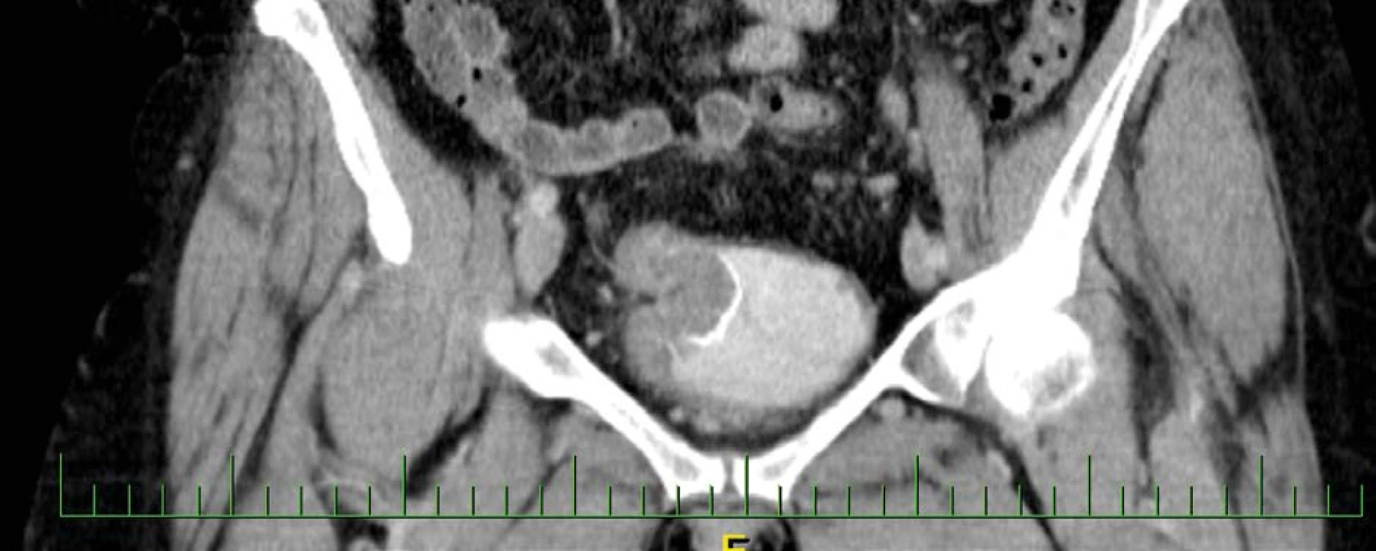CT vyšetření zachycující intraluminální expanzi v augmentovaném močovém měchýři<br>
Fig. 2. CT examination capturing intraluminal expansion in the augmented bladder