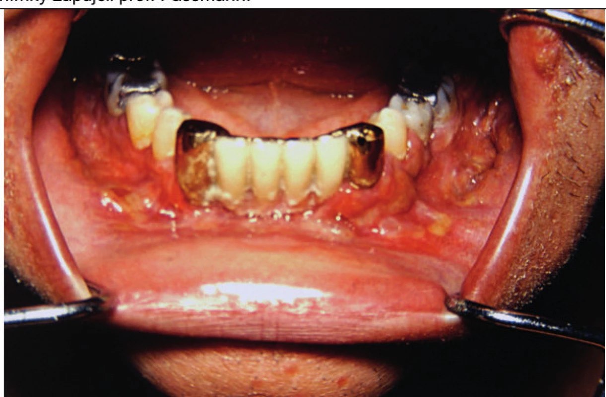 Postižení dásní LCH může způsobit proces podobný
parodontóze a může vést k uvolňování zubů<br>
V některých případech však postihuje i kost a vede k destrukci čelisti.
Tyto snímky zapůjčil prof. Fassmann ze svého archivu.