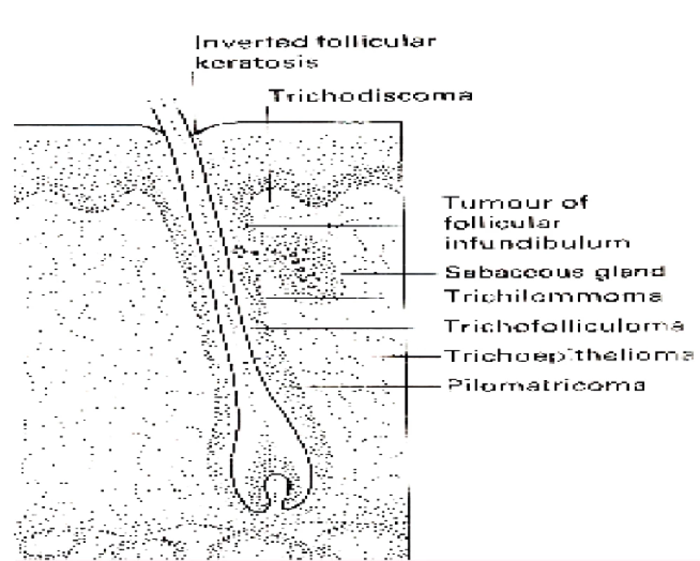 Schematické znázornění lokalizace tumorů vycházejících z vlasového folikulu
(převzato z 10)