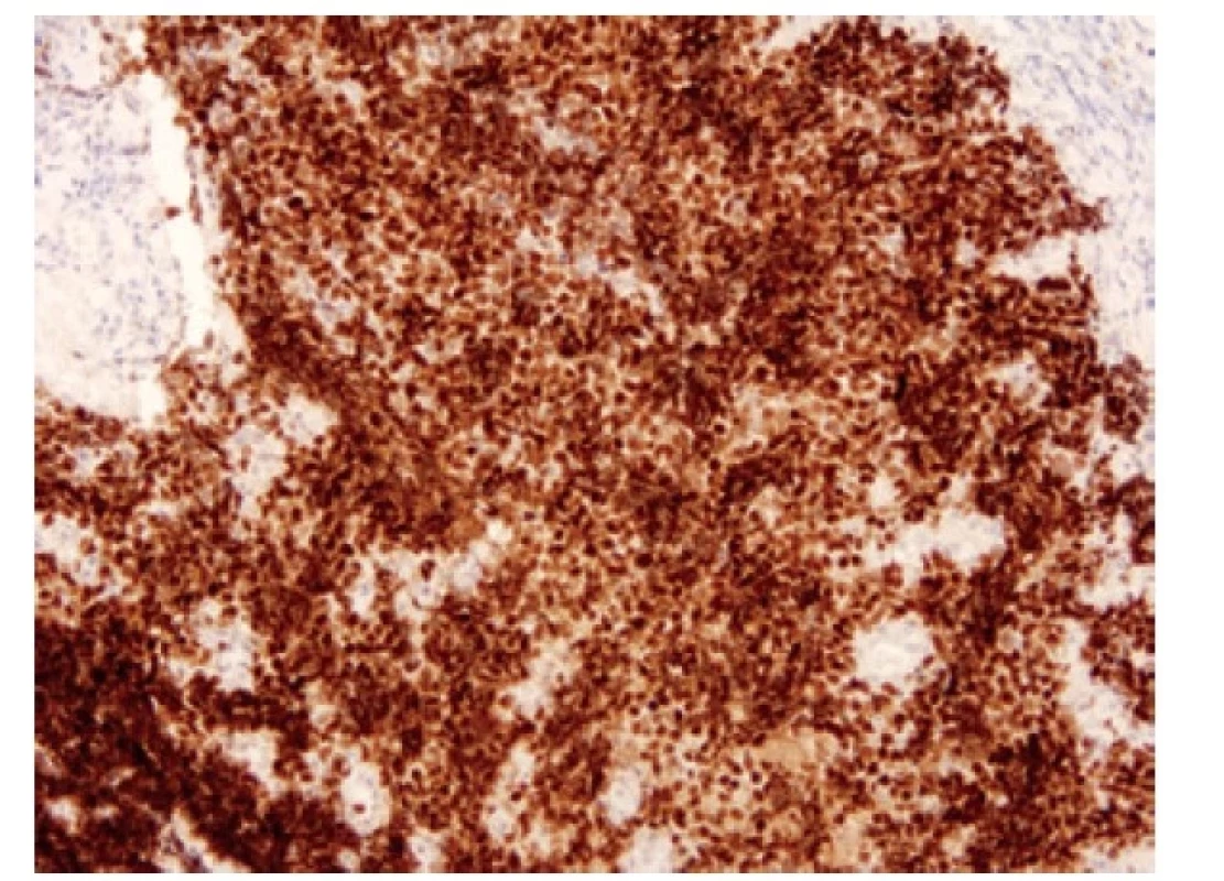 Malobuněčný karcinom pozitivní v imunohistochemickém průkazu
ASCL1. 100x.