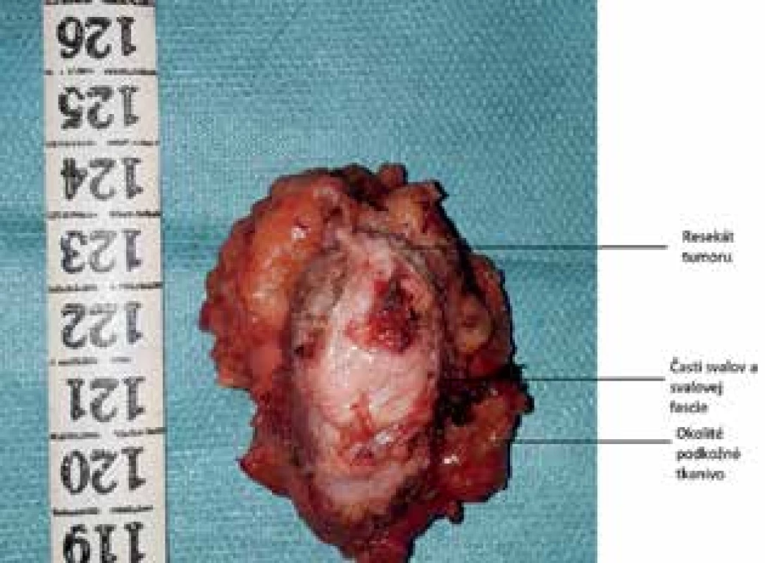 Resekát tumoru brušnej steny<br>
Fig. 4: Resected tumor of the abdominal wall