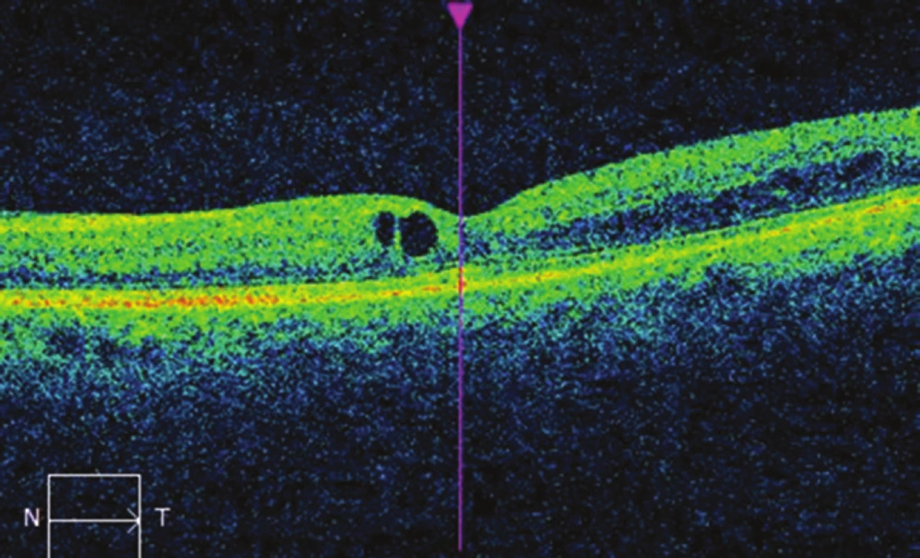OCT image of left eye after micropulse laser treatment:
decrease of macular edema, CRT 284 μm.
