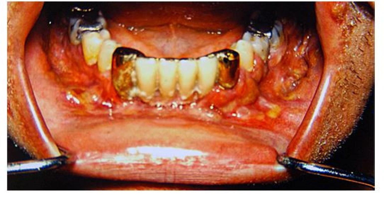Postižení dásní LCH může způsobit proces podobný parodontóze
a může vést k uvolňování zubů. V některých případech však postihuje i kost
a vede k destrukci čelisti. Tyto snímky zapůjčil prof. Fassmann ze svého
archivu