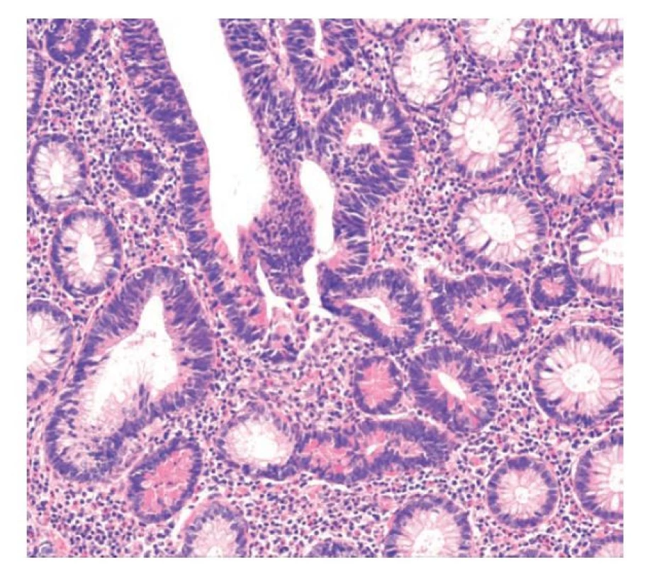 Diferencovaná dysplázie s Panethovými buňkami. V diferencované
dysplázii převažují elementy enterocytárního charakteru s protáhlými
jádry, která jsou v této lézi hyperchromní. Patrné jsou hojné Panethovy buňky
v četných kryptách (hematoxylin a eosin, 200x).