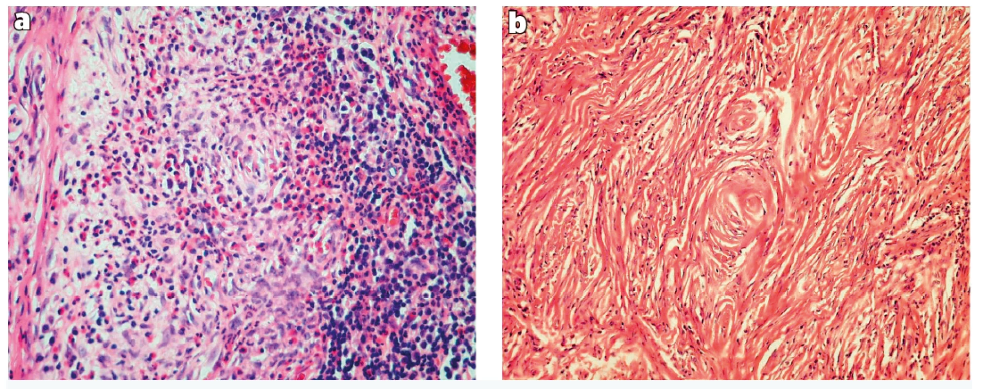 Histological findings.<br>
a) Dense fibrous connective tissue with chronic inflammatory cells and eosinophils surrounding small blood vessels (haematoxylin and
eosin, 200 x)<br>
b) Dense fibrotic stroma with concentric onion-skin perivascular fibrosis (haematoxylin and eosin, 100 x)