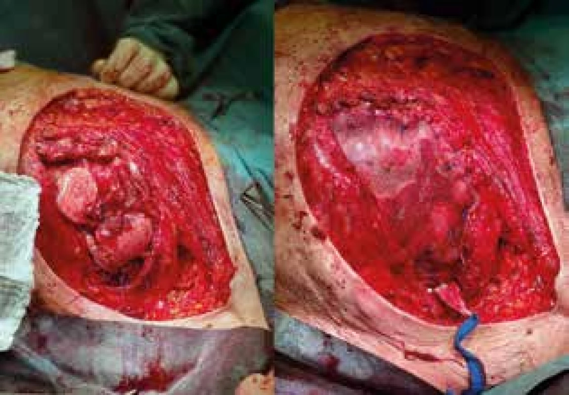 Stav po sanační mastektomii s resekcí hrudní stěny a po implantaci prolene mesh síťky<br>
Fig. 3: Perioperative image showing the patient after
mastectomy,chest wall resection andprolene mesh implantation