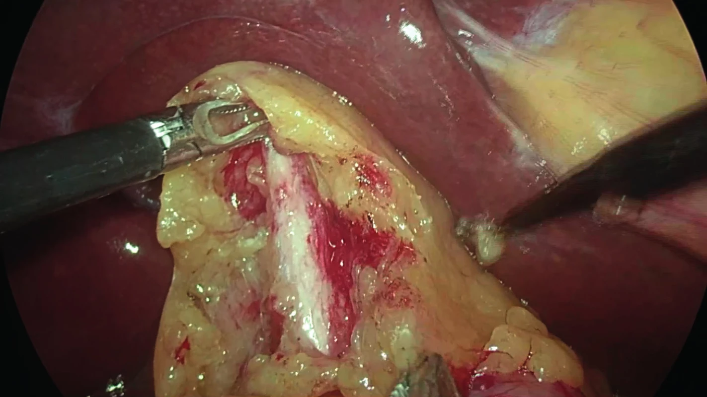 Dissected common hepatic duct (CHD) mistaken
for a shrunken gallbladder