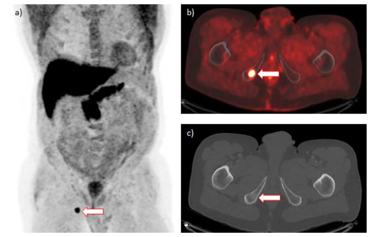 a–c. 18F-fluciklovin PET/CT s nálezem solitární metastázy v dolním raménku kosti stydké vpravo (šipka):
a) maximální projekce intenzity, b) fúze pozitronové emisní tomografie/počítačové tomografie, c) počítačová
tomografie (zobrazení skeletu)<br>
Fig. 1. a–c. 18F-fluciclovine PET/CT positive for solitary metastasis in the inferior ramus of the right pubic bone
(arrow): a) maximum intensity projection, b) positrone emission tomography/computed tomography fusion,
c) computed tomography (bone window)