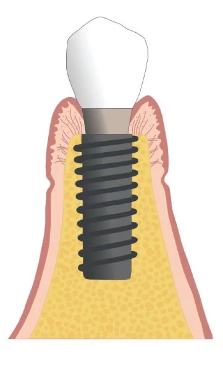 Zdravé peri-implantátové
tkanivá.<br>
Fig. 1
Peri-implant health.