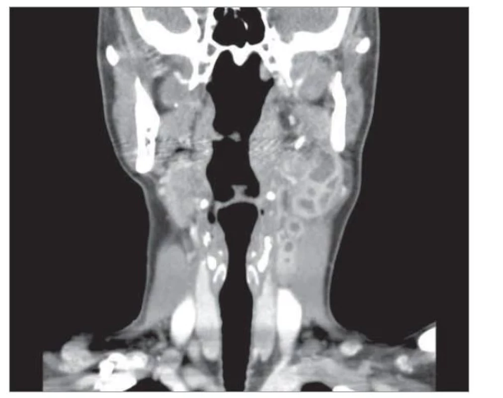 CT krku.<br>
Fig. 2. CT of neck.