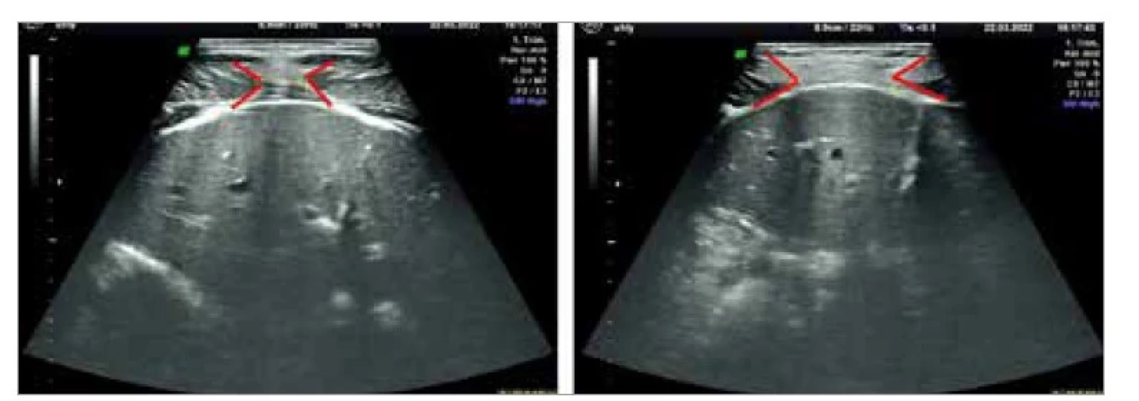Vyšetrenie diastázy m. rectus abdominis prostredníctvom
2D ultrazvuku – naľavo bez diastázy, napravo s miernou diastázou.<br>
Fig. 1. Examination of diastasis m. rectus abdominis through 2D ultrasound –
without
diastasis on the left, with a slight diastasis on the right.