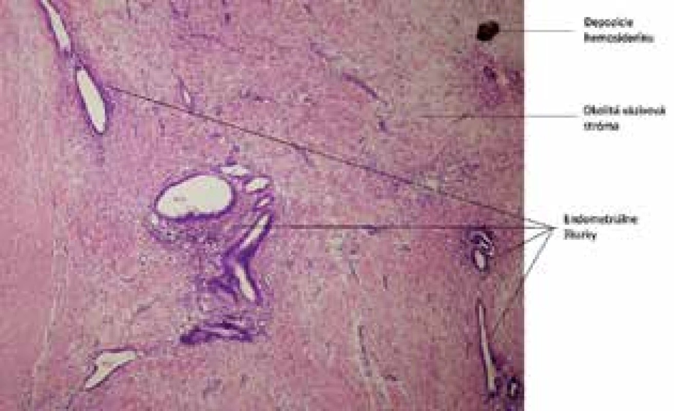 Endometrióza v jazve: prítomné je husté kolagénové väzivo s  prezenciou endometriálnych žliazok. Farbenie Hematoxylín-eozín 40×<br>
Fig. 5: Abdominal wall endometriosis: collagen tissue and 
endometrial glands, HE 40×