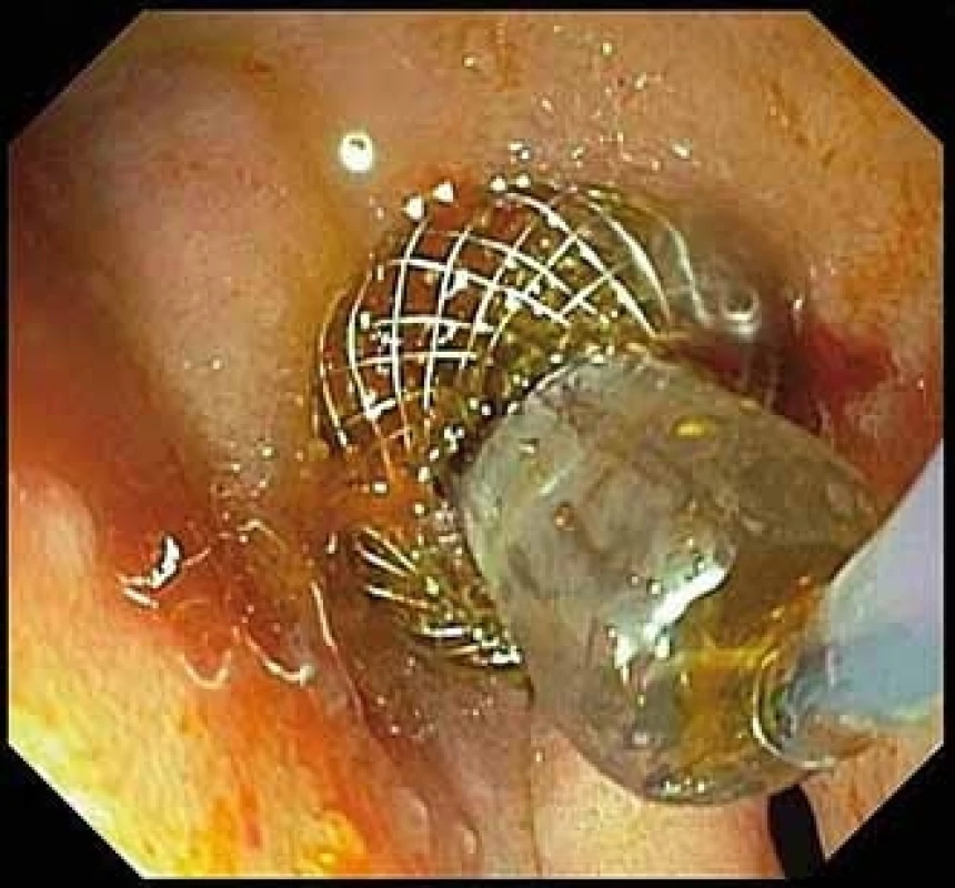 Balonová dilatace stentu.<br>>
Fig. 5. Balloon dilation of the stent.