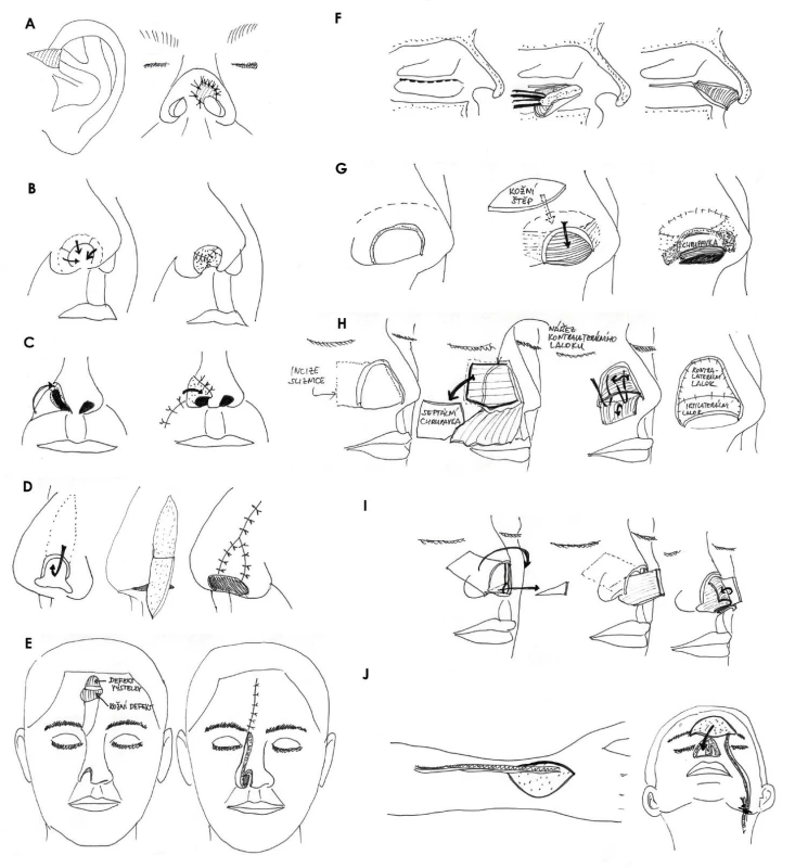 Rekonstrukce vnitřní výstelky nosu: A) kompozitní štěp, B) přetočení okrajů defektu nosu, C)
místní lalok, D) zevní překlopný lalok, E) zdublovaný čelní lalok, F) lalok z dolní skořepy (turbinate flap), G)
dvoustopkový vestibulární kožní lalok, H) septální mukoperichondriální lalok, I) pivotální kompozitní septální
chondromukozní lalok, J) mikrovaskulární volný lalok.
Zdroj: Kresba autora podle Menick Frederick J. Aesthetic nasal reconstruction in Neligan, Peter C. Plastic Surgery,
Vol. III., Craniofacial, Head and Neck Surgery. Elsevier Saunders London, 3rd ed, 2013.