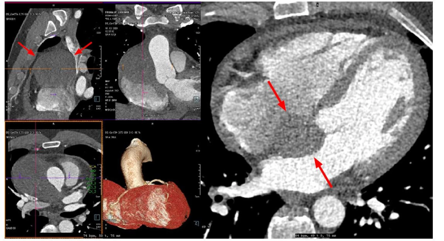 CT angiografie hrudní aorty a koronárních tepen