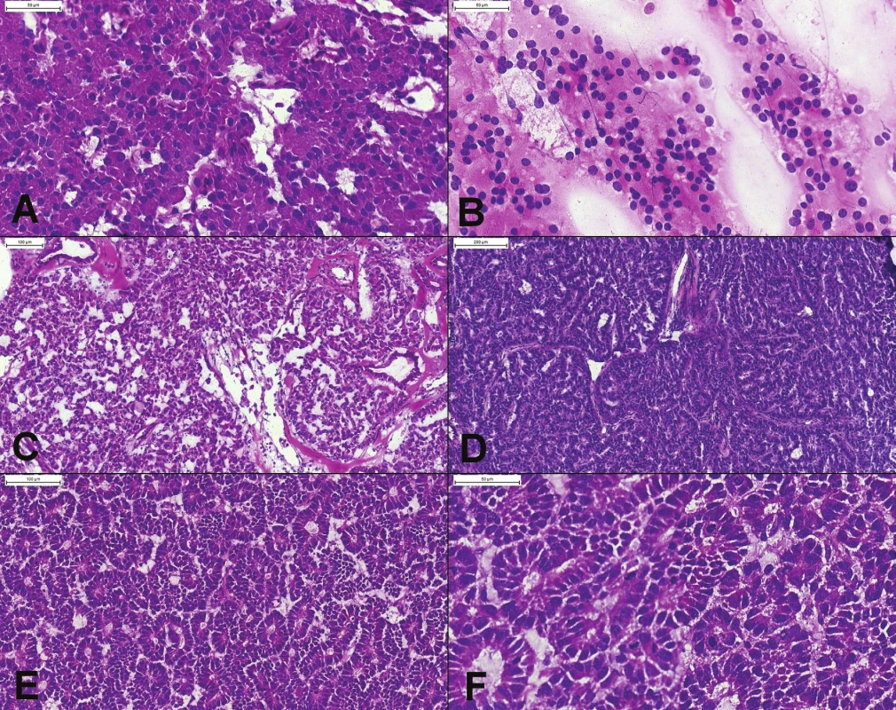 (A) Prevažne solídne rastúci dobre diferencovaný neuroendokrinný tumor, tvorený bunkami s eozinofilnou cytoplazmou,
uniformnými okrúhlymi excentricky umiestnenými jadrami, bez mitóz. (B) Peroperačný cytologický náter potvrdzujúci diagnózu
– diskohezívna populácia blandných plazmocytoidných buniek s blandným chromatínom, bez nápadnejších jadierok. (C, D)
Pseudoglandulárne, trabekulárne a acinárne usporiadanie niektorých NET-ov môže spôsobiť diagnostické ťažkosti. Podobnú architektoniku
môže mať acinárny karcinóm. (E) Acinárny karcinóm pankreasu. Tumor má difúzne acinárne usporiadanie, s bazálne
lokalizovanými jadrami. (F) Výrazná mitotická aktivita (6 mitóz v jednom poli) je v dobre diferencovaných NET-och vzácna. Prominentné
jadierka typické pre acinárny karcinóm v zmrazenom reze neboli dobre viditeľné.
