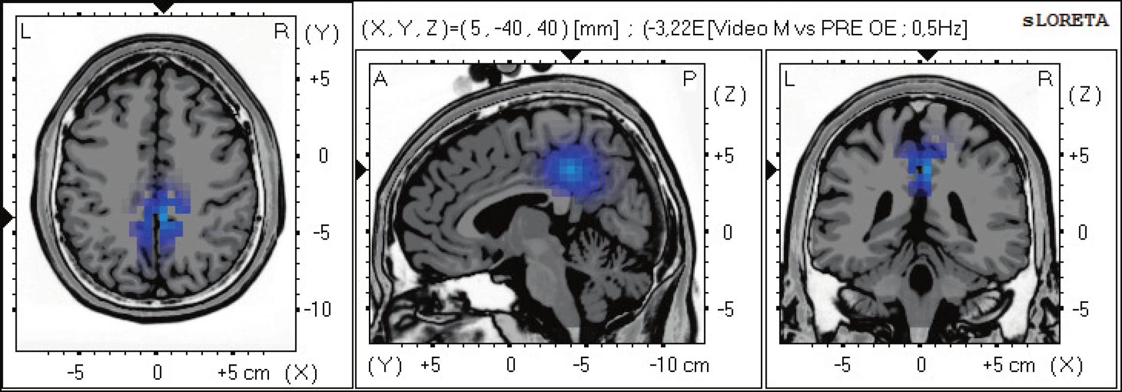 Statistické ne-parametrické mapy sLORETA diference v beta-2 pásmu při porovnání pozorování 2D videa oproti klidovému
záznamu při otevřených očích. Modrá barva znamená snížení zdrojové aktivity v gyrus cinguli BA 31, a precuneu BAs 7,5. Anatomické řezy
Talairachova obrazu mají šedou barvu (L – vlevo, R – vpravo).